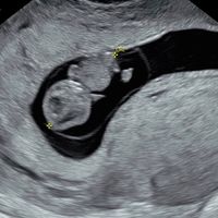Ayuda con método ramzi: niño o niña? - 1