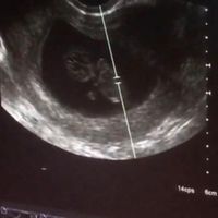 Ayuda con método ramzi: niño o niña? - 1