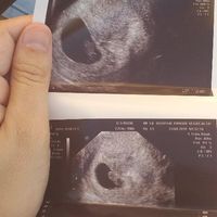 Ayuda con método ramzi: niño o niña? - 1