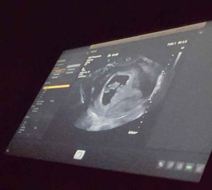 Ayuda con método ramzi: niño o niña? 1