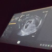 Ayuda con método ramzi: niño o niña? - 1
