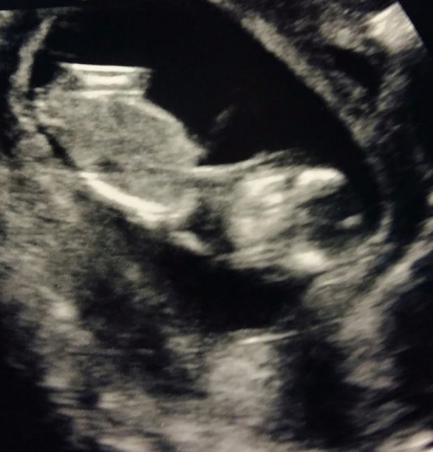 12 semanas 