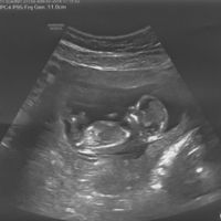 Ayuda con método ramzi: niño o niña? - 1