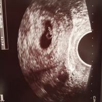 Ayuda con método ramzi: niño o niña? - 1