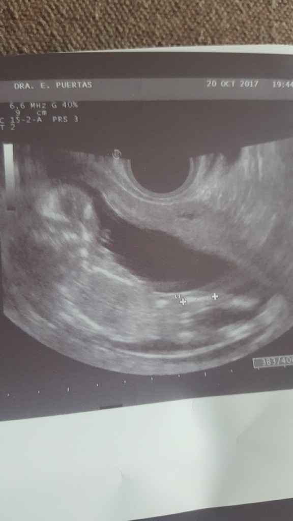 Ecografias primer trimestre: niña o niño? - 1