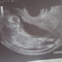  Ecografias primer trimestre: niña o niño? - 1