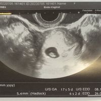 Ayuda con método ramzi: niño o niña? - 1