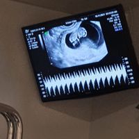 Ayuda con método ramzi: niño o niña? - 1