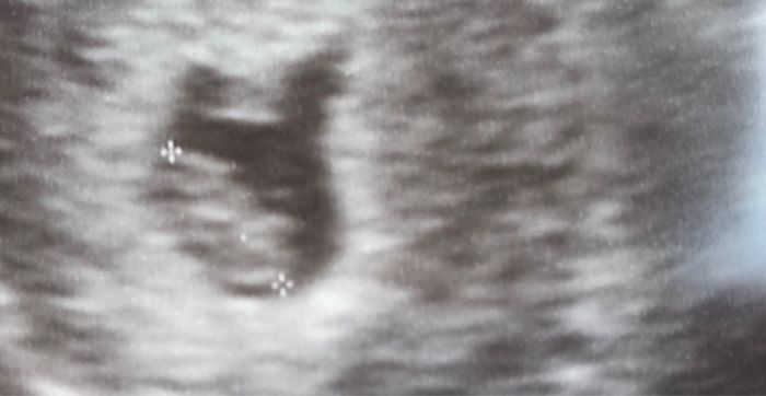 Ayuda con método ramzi: niño o niña? - 1