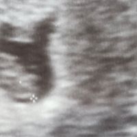Ayuda con método ramzi: niño o niña? - 1