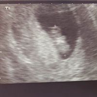 Ayuda con método ramzi: niño o niña? - 1