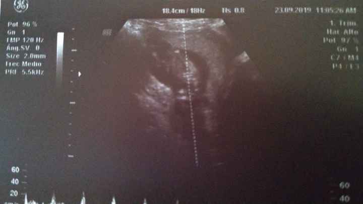 Ayuda con método ramzi: niño o niña? 16