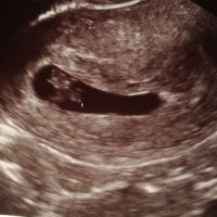 Ayuda con método ramzi: niño o niña? - 2
