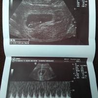 Ayuda con método ramzi: niño o niña? - 1