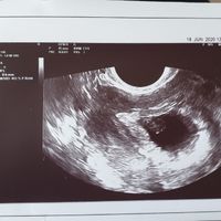 Ayuda con método ramzi: niño o niña? - 1