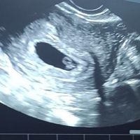 Ayuda con método ramzi: niño o niña? - 1