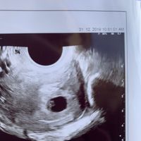 Ayuda con método ramzi: niño o niña? - 1