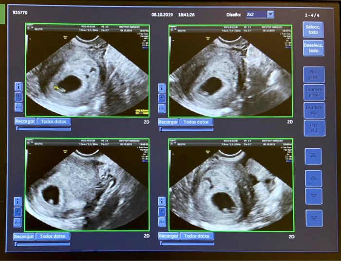 Embarazo y endometriosis 1