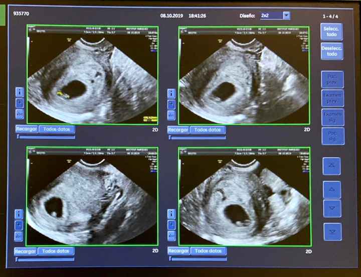 Embarazo y endometriosis - 1