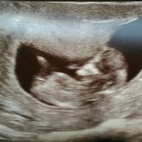 Ayuda con método ramzi: niño o niña? - 1