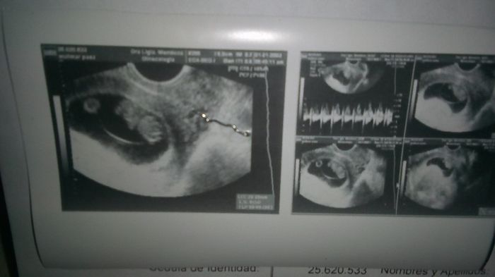 Hola chicas tengo 8+5 y fue transvaginal sus actividad cardíaca es de 180 soy primeriza no conozco m
