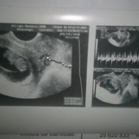 Hola chicas tengo 8+5 y fue transvaginal sus actividad cardíaca es de 180 soy primeriza no conozco m