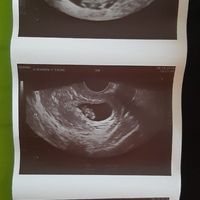 Ayuda con método ramzi: niño o niña? - 1
