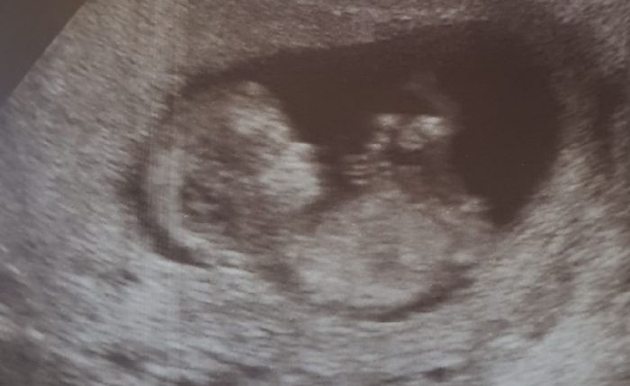 ¡¡¡hola a todas!!! Opinión tubérculo genital 3