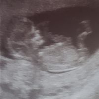 Tubérculo genital: niña - 1