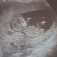 Tubérculo genital: niña - 2