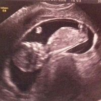Ayuda con método ramzi: niño o niña? - 1