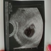Ayuda con método ramzi: niño o niña? - 1