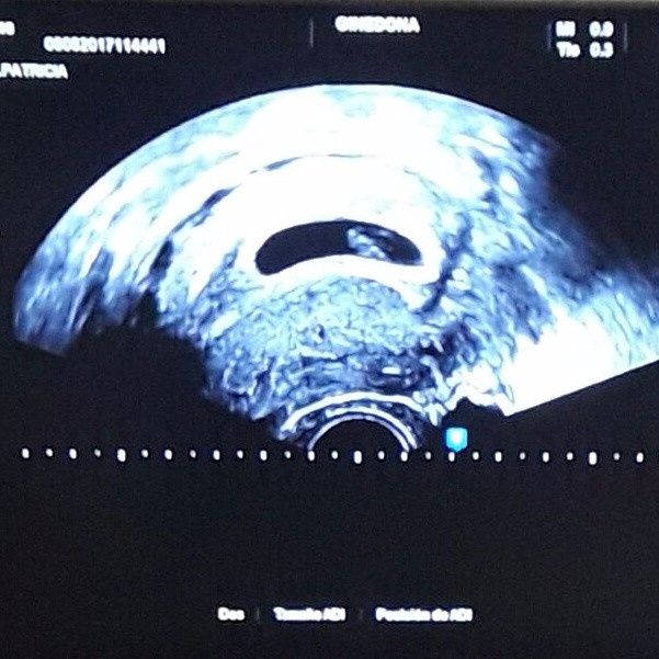 ECO TRANSVAGINAL