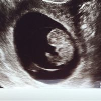 Ayuda con método ramzi: niño o niña? - 1
