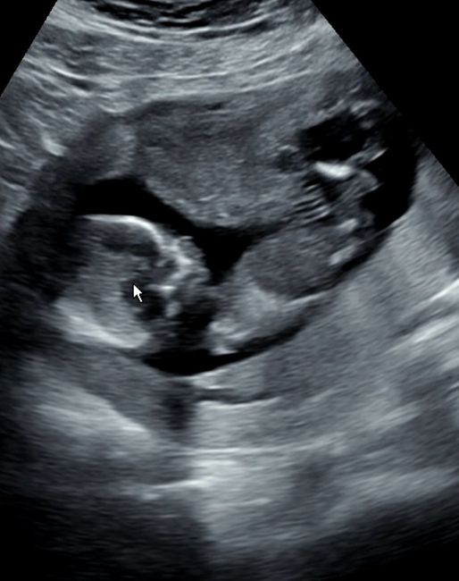 Ayuda con método ramzi: niño o niña? - 1