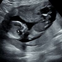Ayuda con método ramzi: niño o niña? - 1