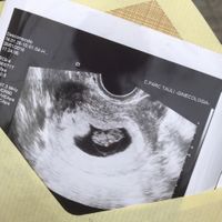 Ayuda con método ramzi: niño o niña? - 1