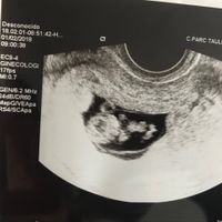 Ayuda con método ramzi: niño o niña? - 2