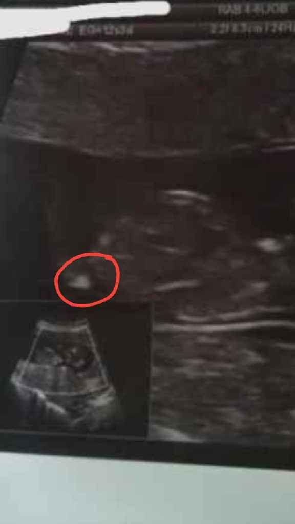 Ayuda con método ramzi: niño o niña? - 1