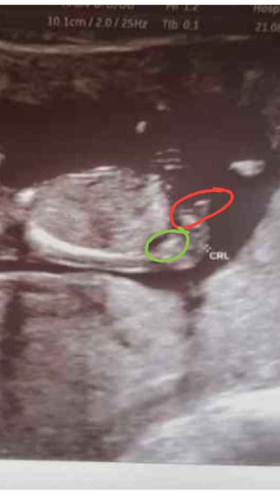 Ayuda con método ramzi: niño o niña? - 1