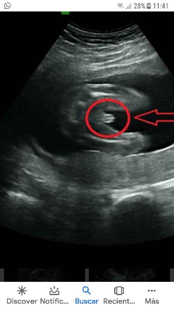 Tubérculo genital: niña - 2