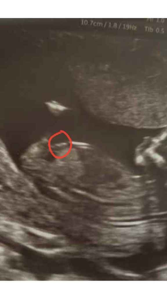 Ayuda con método ramzi: niño o niña? - 1