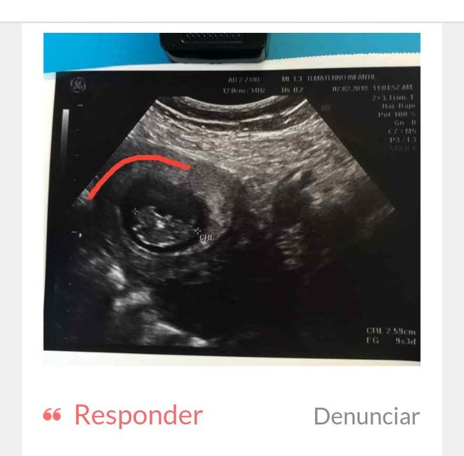 Ayuda con método ramzi: niño o niña? - 2