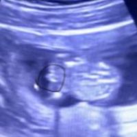 Ayuda con método ramzi: niño o niña? - 1