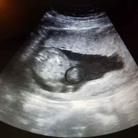 Ayuda con método ramzi: niño o niña? - 2