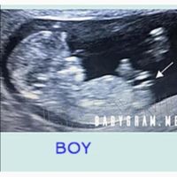 Ayuda con método ramzi: niño o niña? - 1