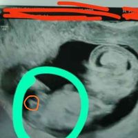 Ayuda con método ramzi: niño o niña? - 1