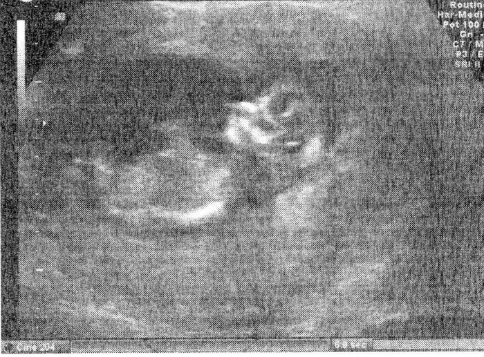 Ayuda con método ramzi: niño o niña? - 1