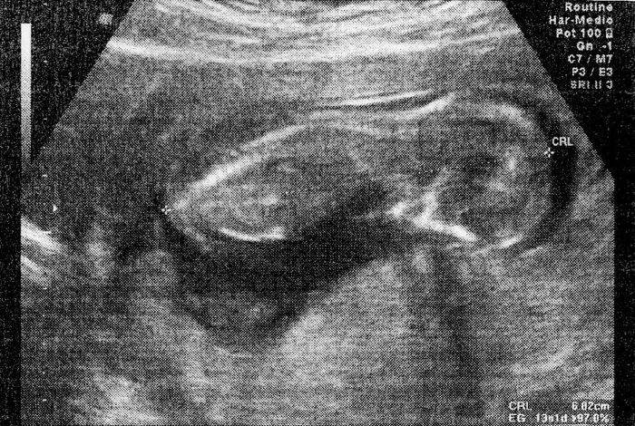 Ayuda con método ramzi: niño o niña? - 2