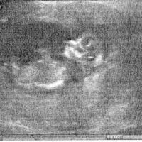 Ayuda con método ramzi: niño o niña? - 1